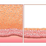 Kas teadsid, et erinevate uuringute põhjal kannatab lausa 50-80% naistest menopausaalse urogenitaalse sündroomi (ingl. k. (menopausal genitourinary syndrome, GSM) käes? Urogenitaalsündroomi vaevused võivad end presenteerida väga erineval moel: Ometi ei kuule nendest teemadest just sageli. On naisi, kes seostavad seda vananemisega ega ole kursis sellega, et need vaevused on tingitud menopausijärgsest östrogeenitaseme langusest ja selle […]