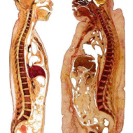 Pildil on väga ülekaalulise mehe pikilõige võrreldes normaalkaalus mehega.Massiivsed rasvaladestused on tekkinud nii tema naha alla kui ka kõhuõõnde ja elunditesse. Oma eluajal kaalus see inimene umbes 150 kilogrammi. Rasvumine on otsetee paljude krooniliste haigusteni, k.a. südame- ja hingamisteede haigused, kõrge vererõhk, suhkurtõbi ja teatud tüüpi vähid. Suureneb ka insuldi risk. Ülekaalulisus mõjutab ka eeldatavat […]